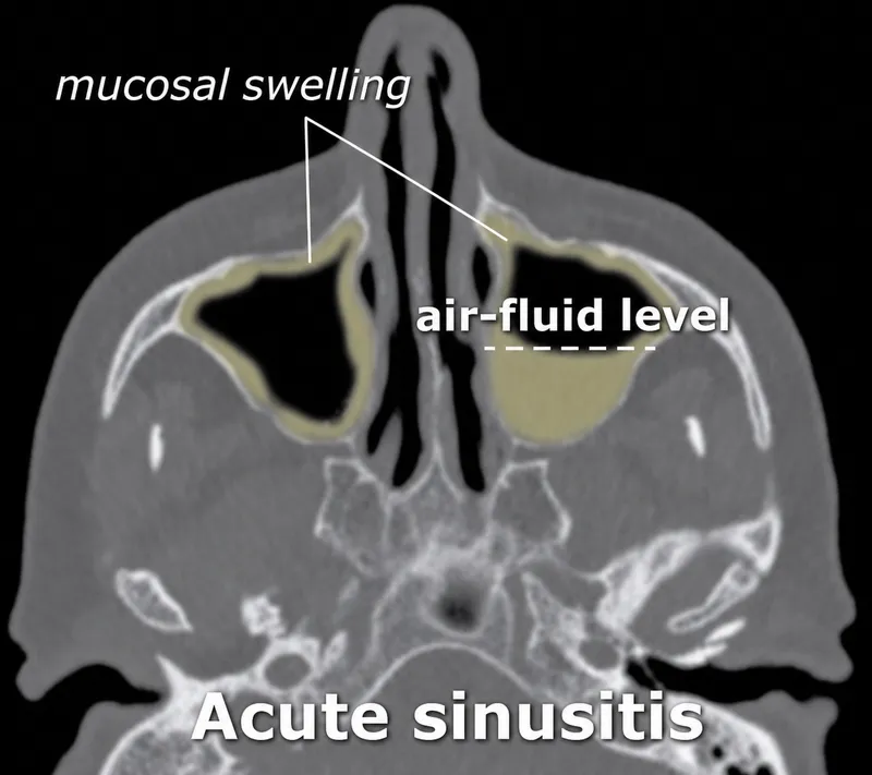 CT scan showing mucosal swelling and air-fluid level
