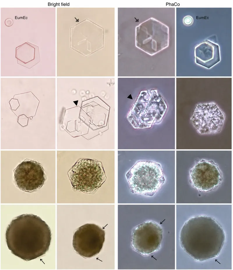 Hexagonal cystine crystals in urine sediment