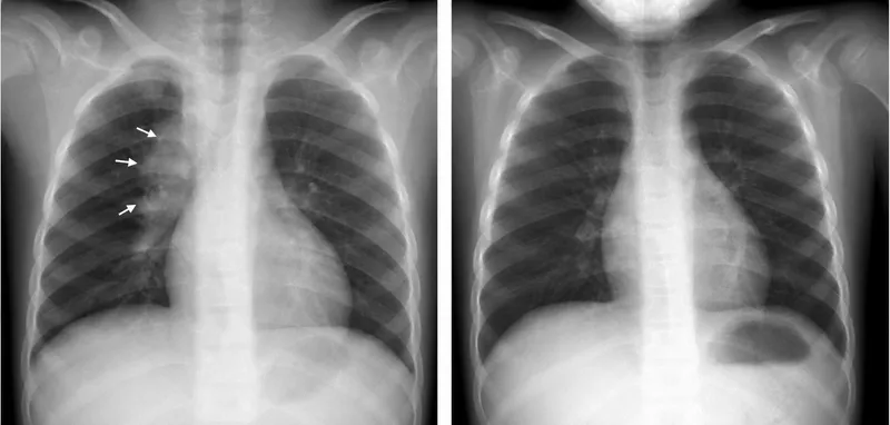 Pediatric CXR primary TB hilar lymphadenopathy