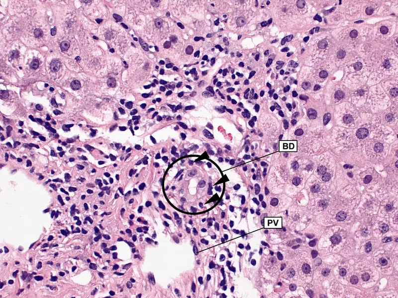 Acute cellular rejection in liver transplant