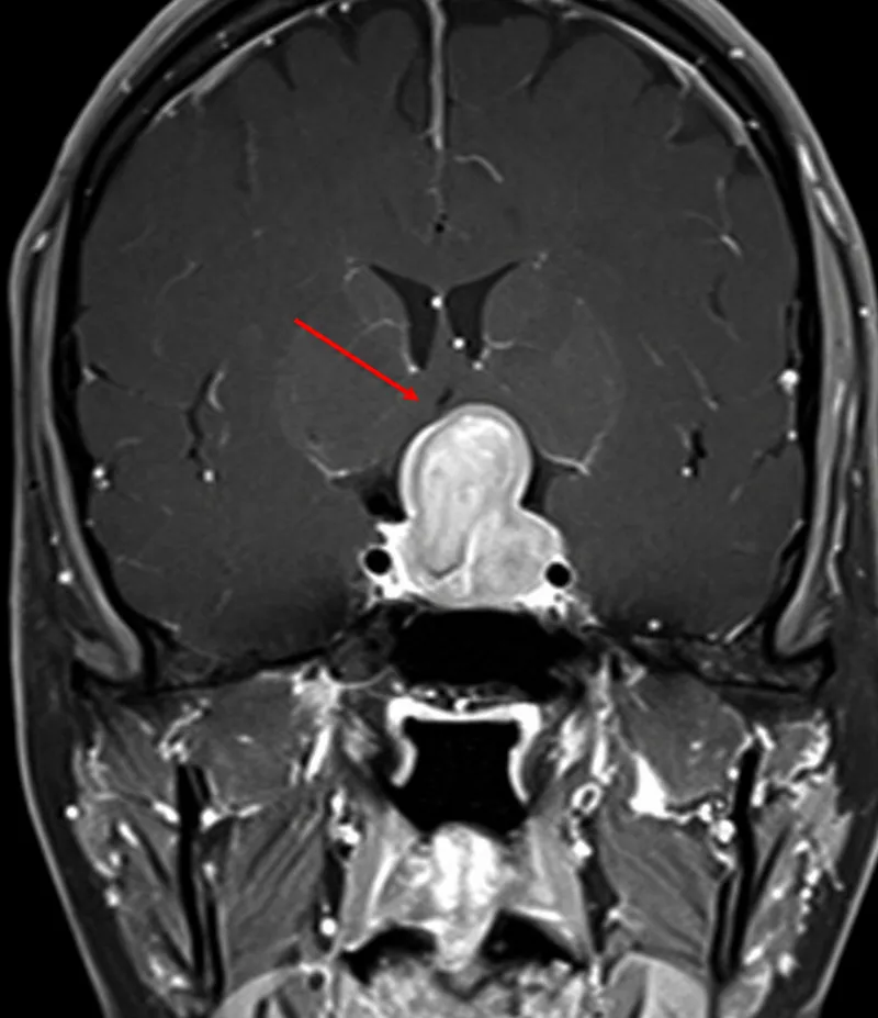 MRI Pituitary Adenoma Compressing Optic Chiasm