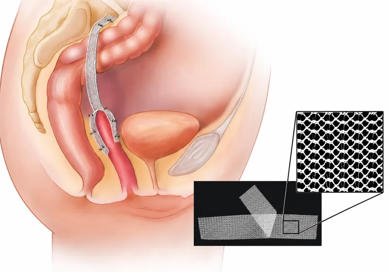 Sacrocolpopexy surgical procedure with mesh