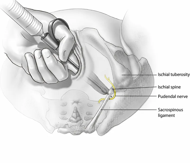 Pudendal nerve block landmark ischial spine
