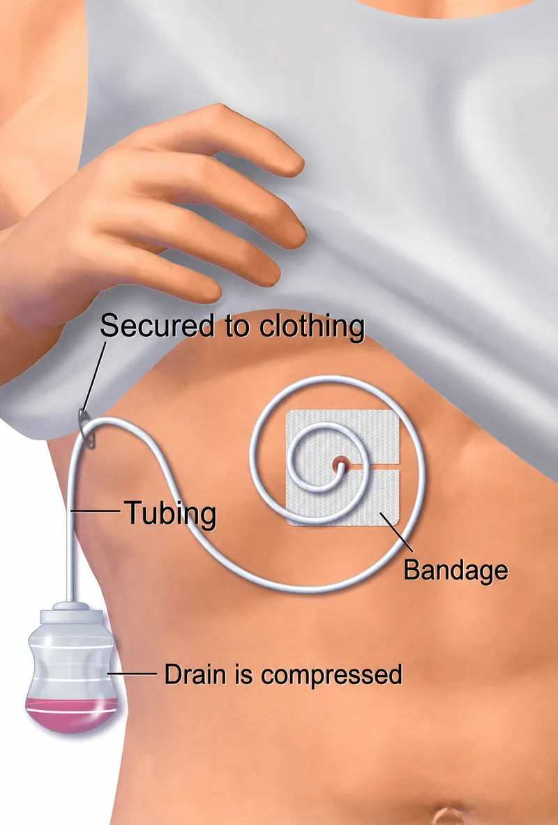 Jackson-Pratt Drain Placement and Management