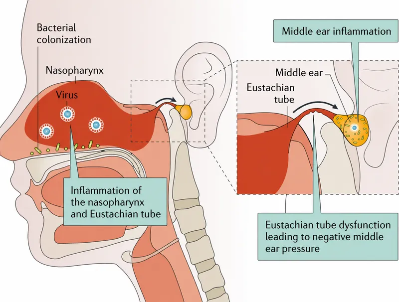 Acute Otitis Media Inflammation Pathway