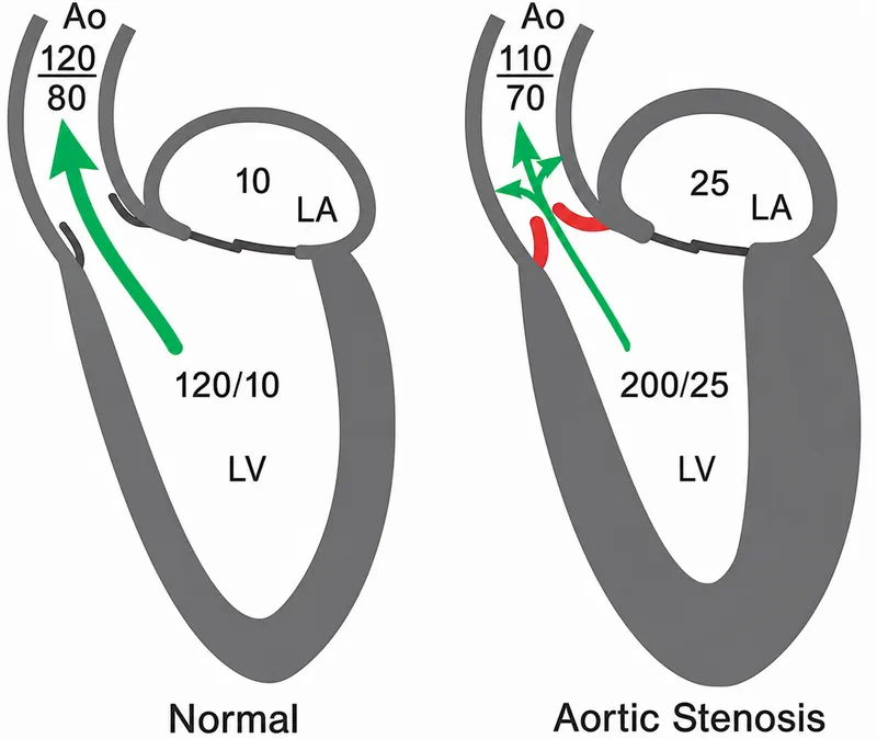 Pressure gradients in normal vs. aortic stenosis