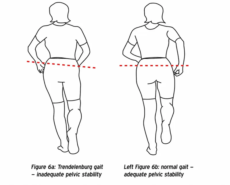 Trendelenburg vs. Normal Gait: Pelvic Stability
