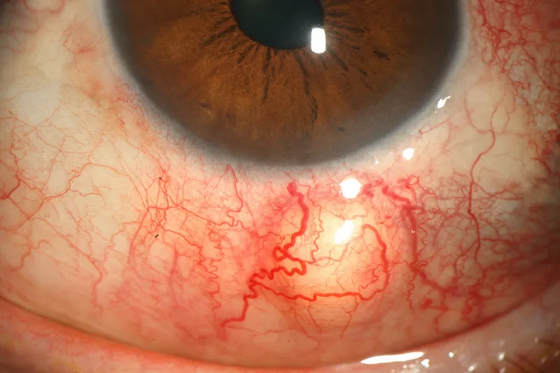 Clinical photograph of nodular scleritis showing characteristic immobile nodules