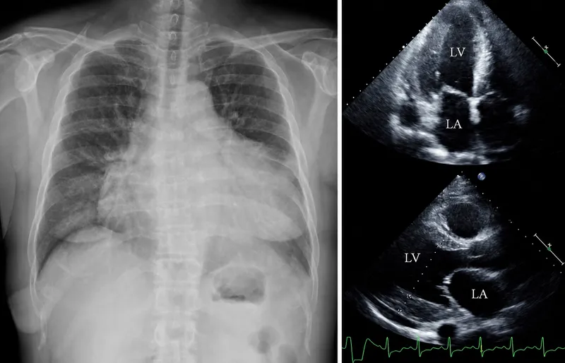 Echocardiogram: Concentric LVH in Acromegaly