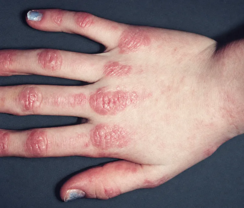 Gottron's papules on hand in dermatomyositis