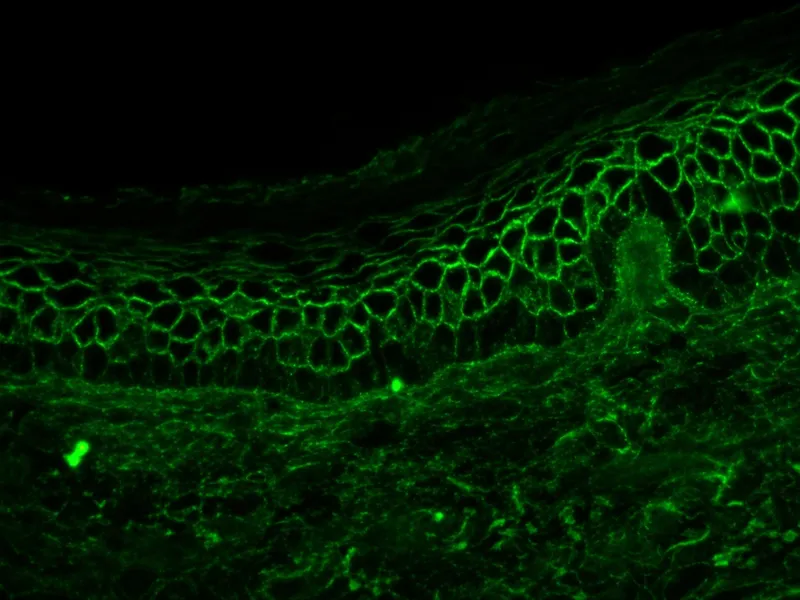 Direct immunofluorescence in Pemphigus Foliaceus