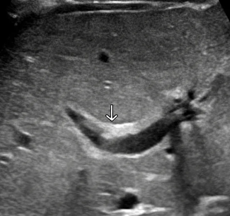 Ultrasound: Triangular cord sign in biliary atresia