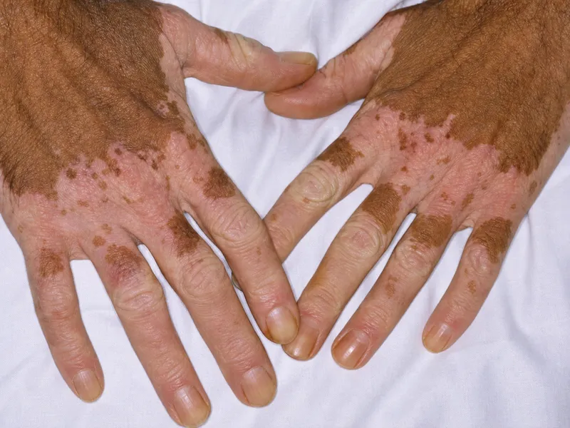 Occupational leukoderma on hands