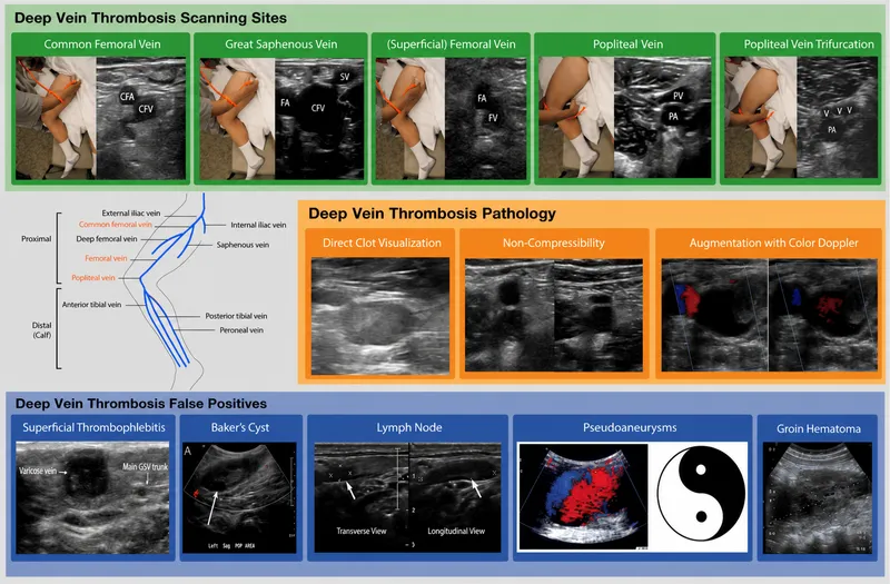 Figure 1: Doppler ultrasound showing non-compressible femoral vein with echogenic thrombus