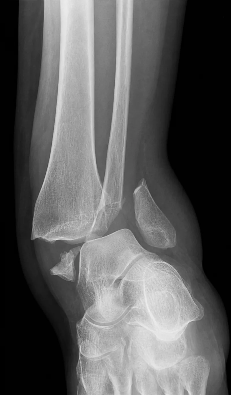 Radiograph of ankle fracture and dislocation