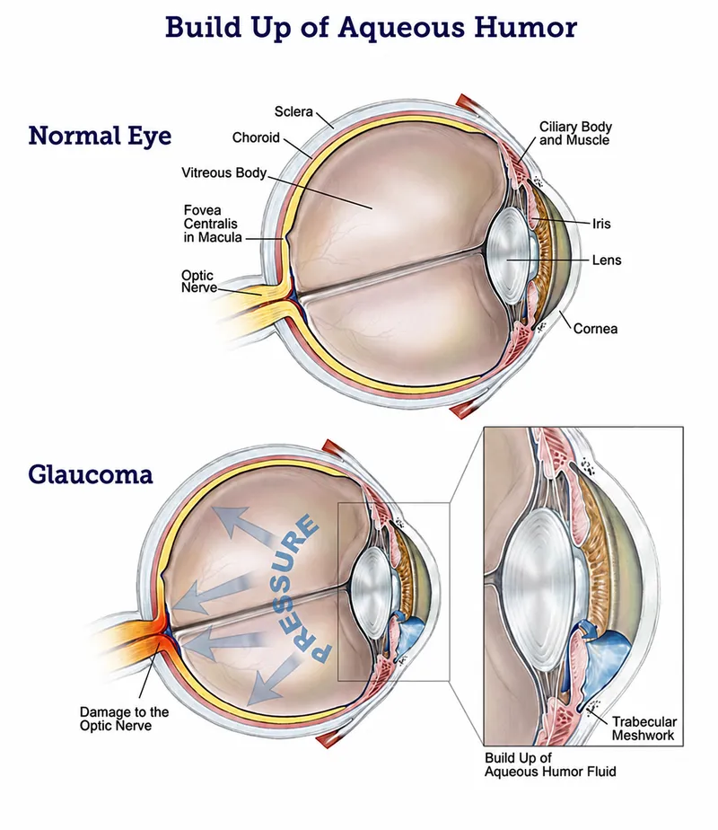 Aqueous Humor Build Up in Glaucoma