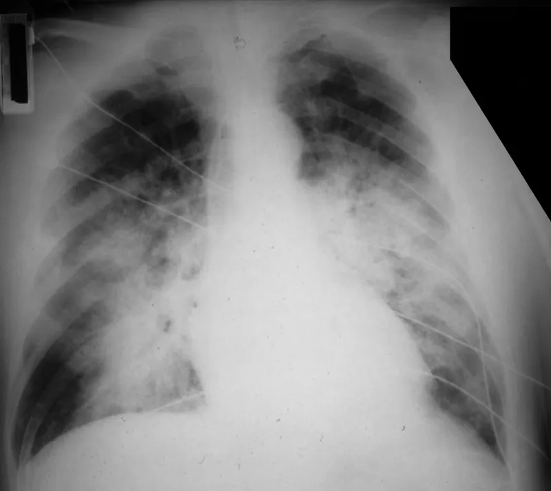 Chest X-ray: Bilateral diffuse opacities in ARDS