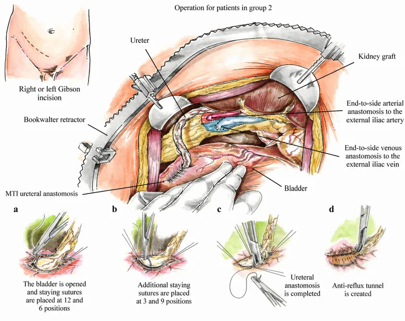 Kidney Transplant: Surgical Anatomy & Ureteral Anastomosis