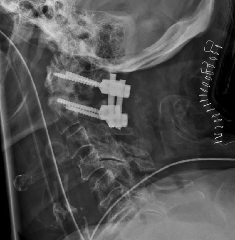 Cervical spinal fusion X-ray with pedicle screws and rods