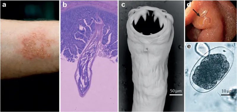 Hookworm infection: skin, histology, adult, and egg