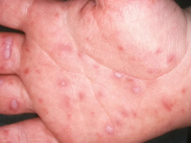 Vesicular lesions on palm in Hand Foot Mouth Disease