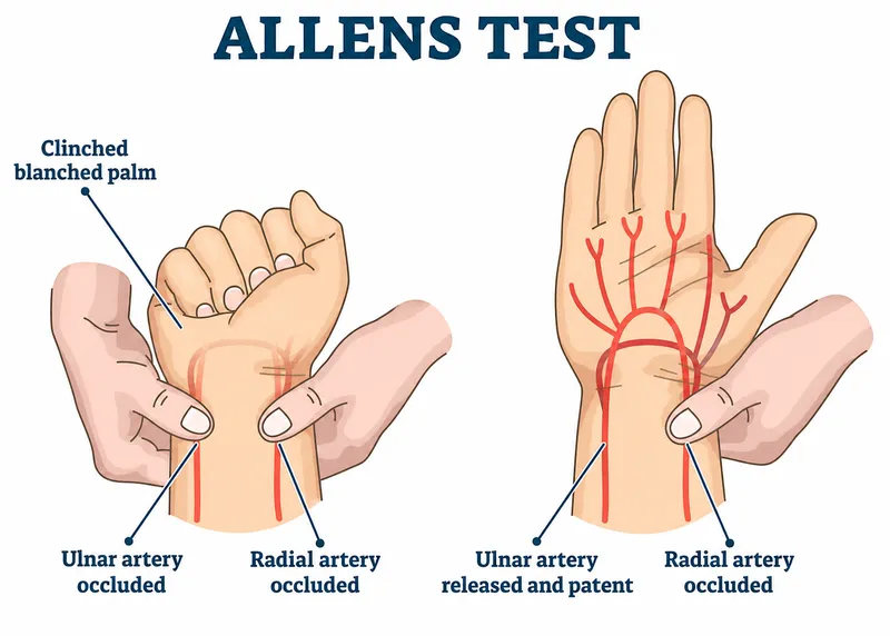 Allen's Test Procedure for Ulnar and Radial Artery Patency