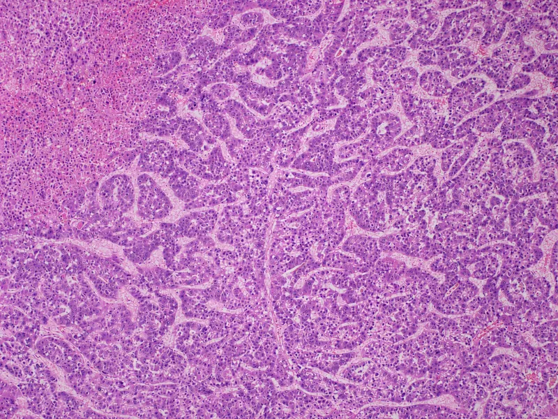 Hepatocellular Carcinoma in HBV/HCV Co-infection