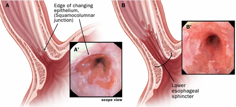 Normal vs. GERD-affected esophagus