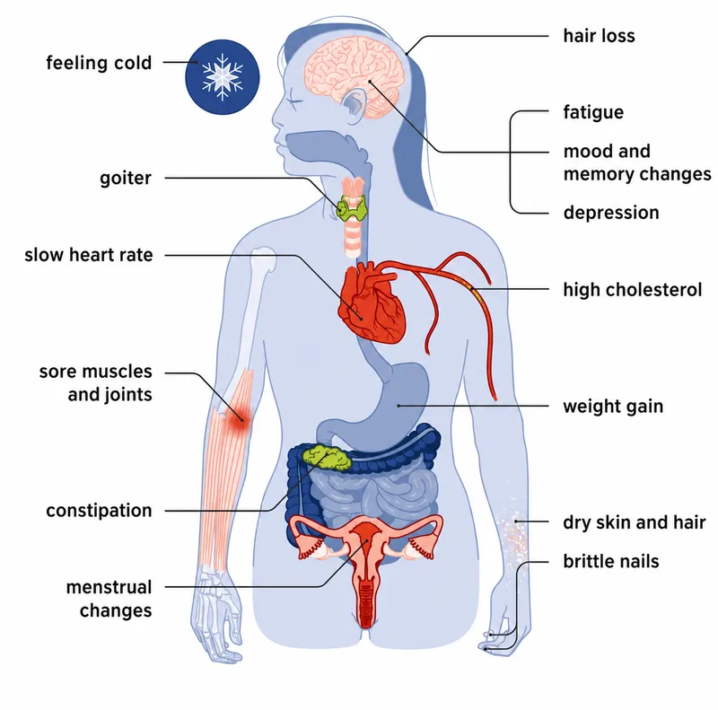 Hypothyroidism: Effects on the Body