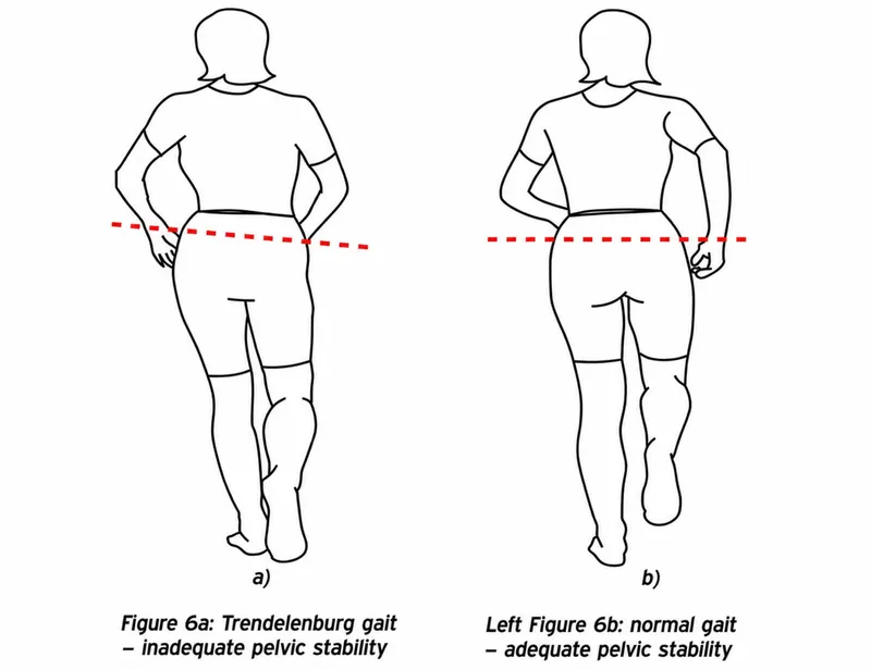 Trendelenburg gait vs normal gait