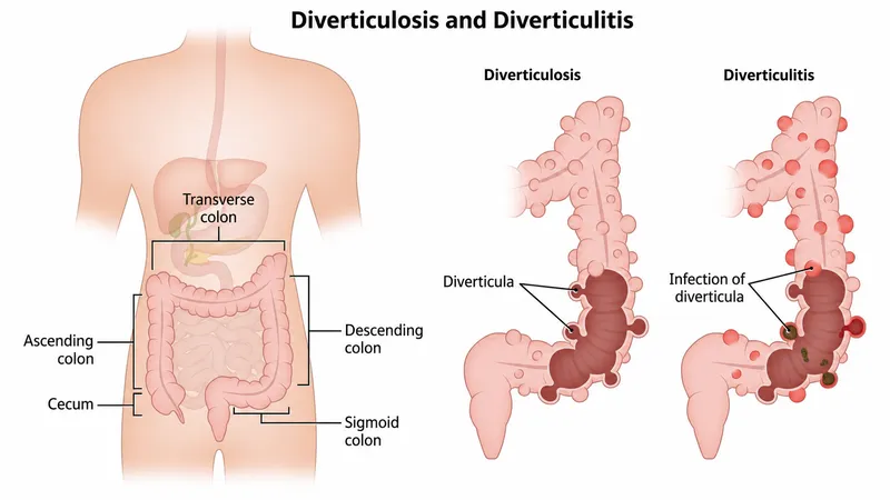 Diverticulosis vs. Diverticulitis: Anatomical Comparison