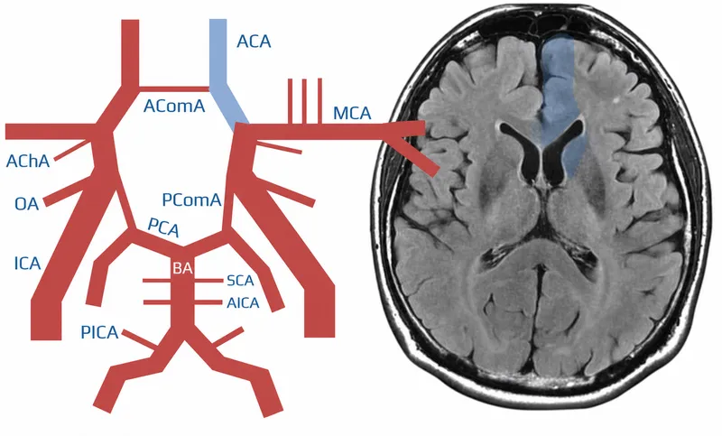 Brain MRI showing stroke lesion with corresponding deficit pattern