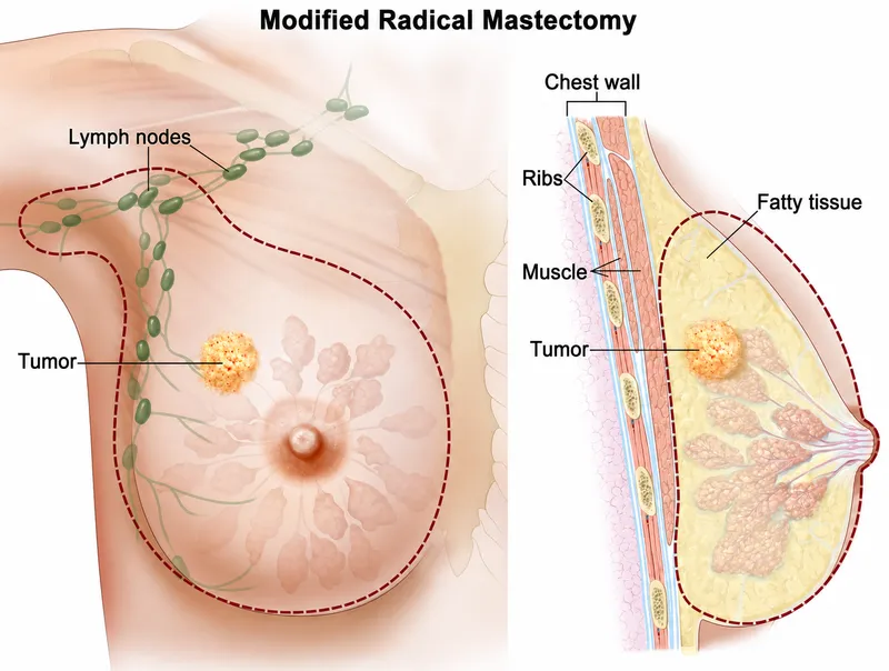 Modified Radical Mastectomy for Breast Cancer