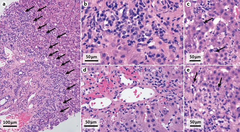 Histopathology of Autoimmune Hepatitis