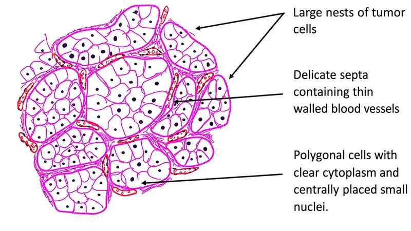 Clear Cell Renal Carcinoma Histopathology Diagram