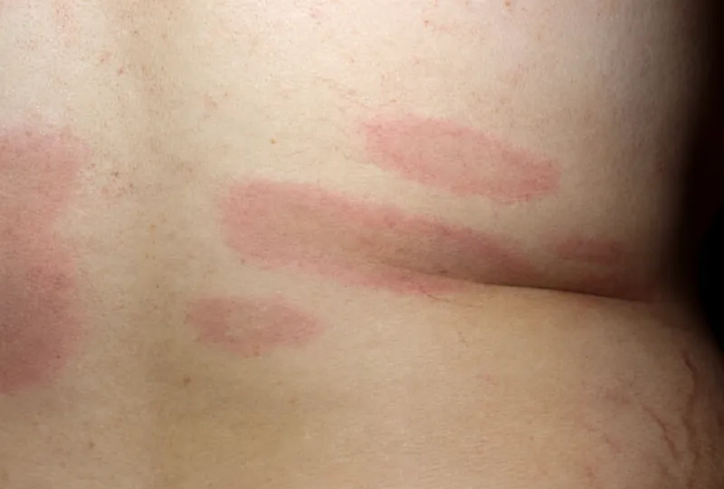 Multiple Erythema Migrans Lesions