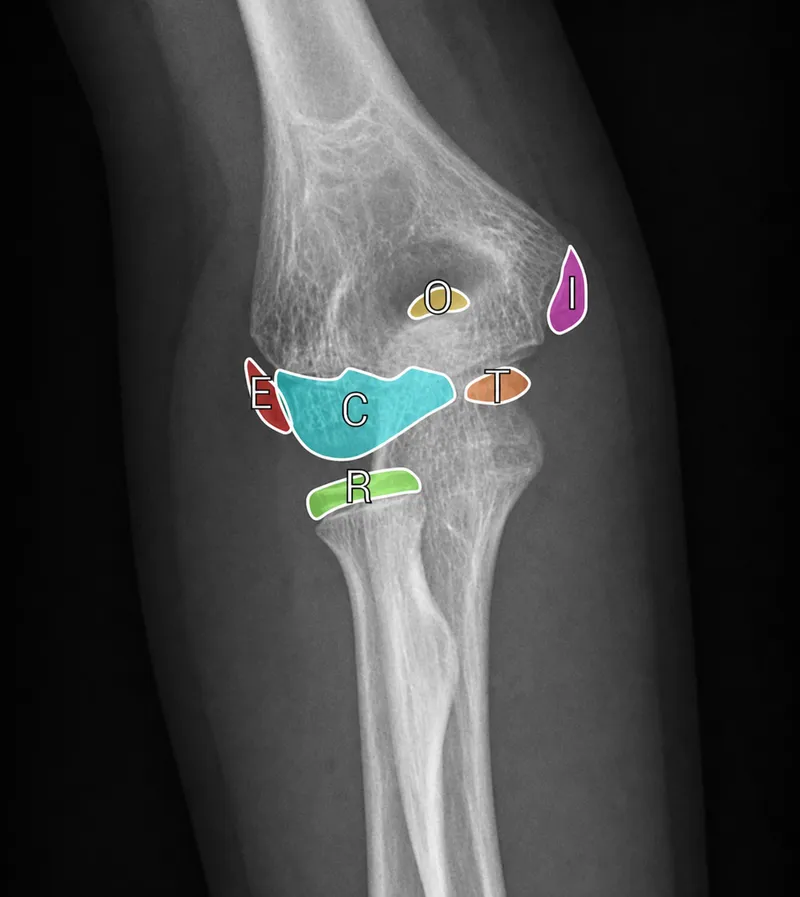 Pediatric elbow ossification centers (CRITOE)