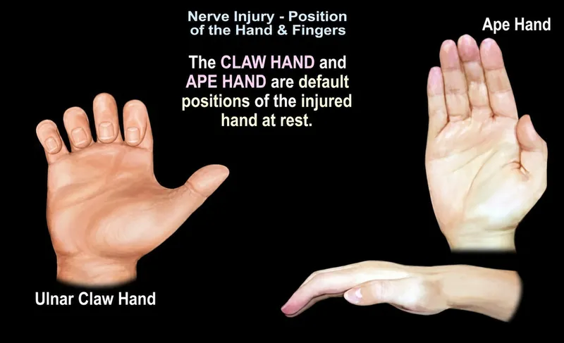 Ulnar Claw Hand and Ape Hand deformities