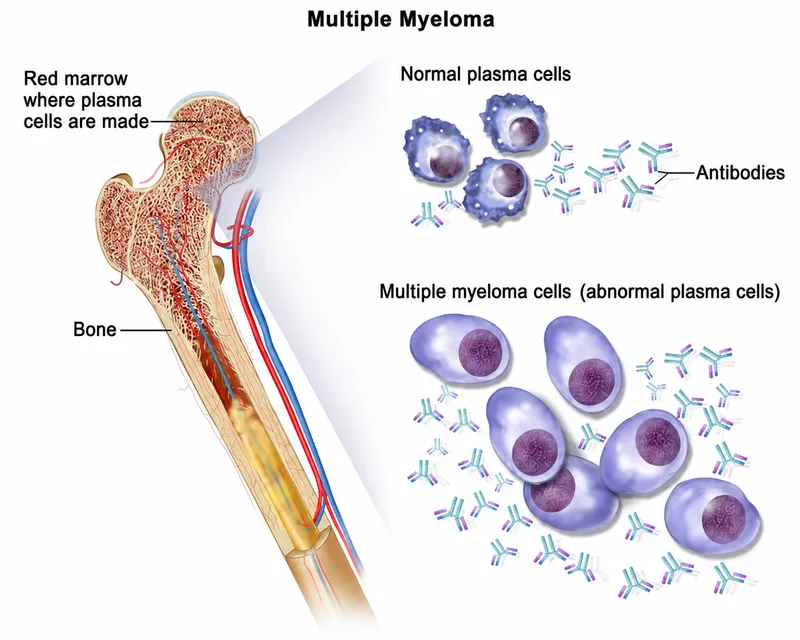 Multiple Myeloma: Bone Marrow and Plasma Cells