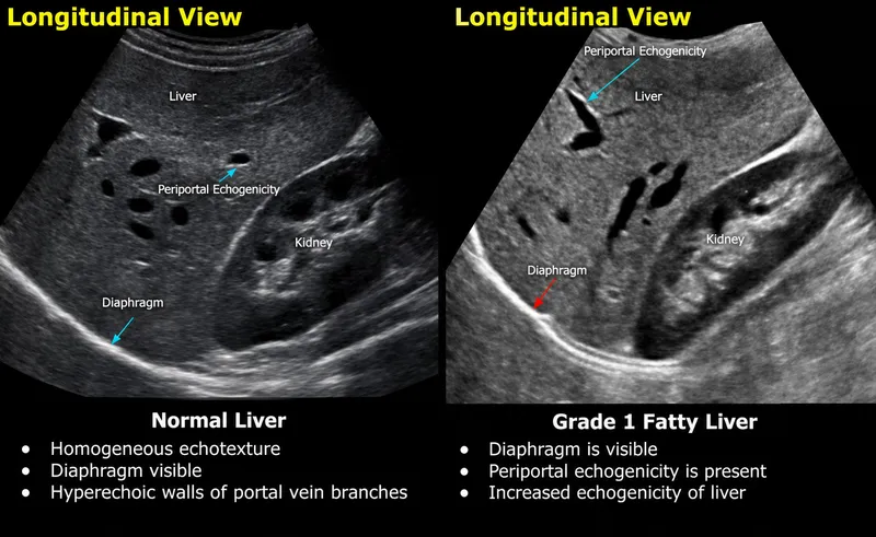 Ultrasound: Normal vs. Grade 1 Fatty Liver