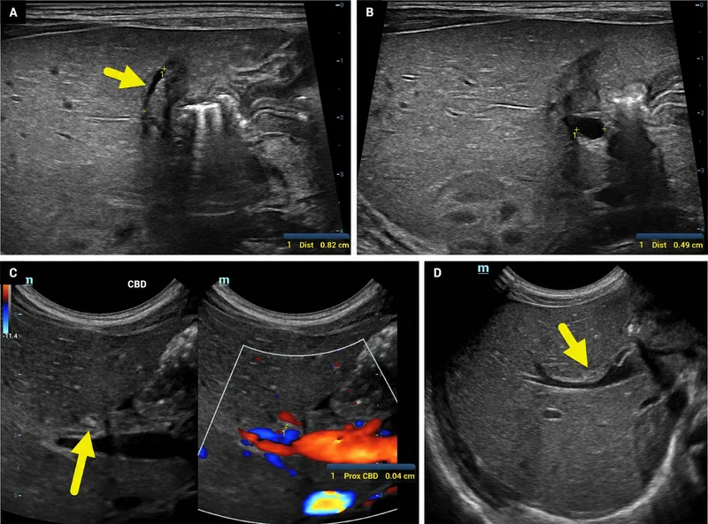 Ultrasound findings in biliary atresia