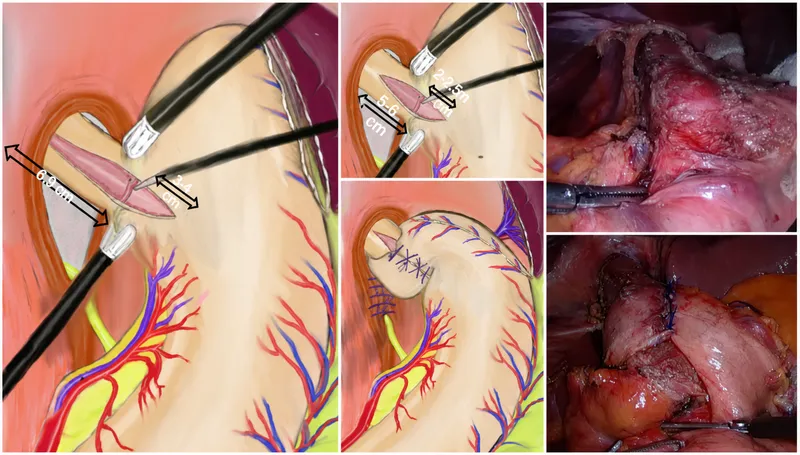Heller Myotomy and Dor Fundoplication Surgical Steps