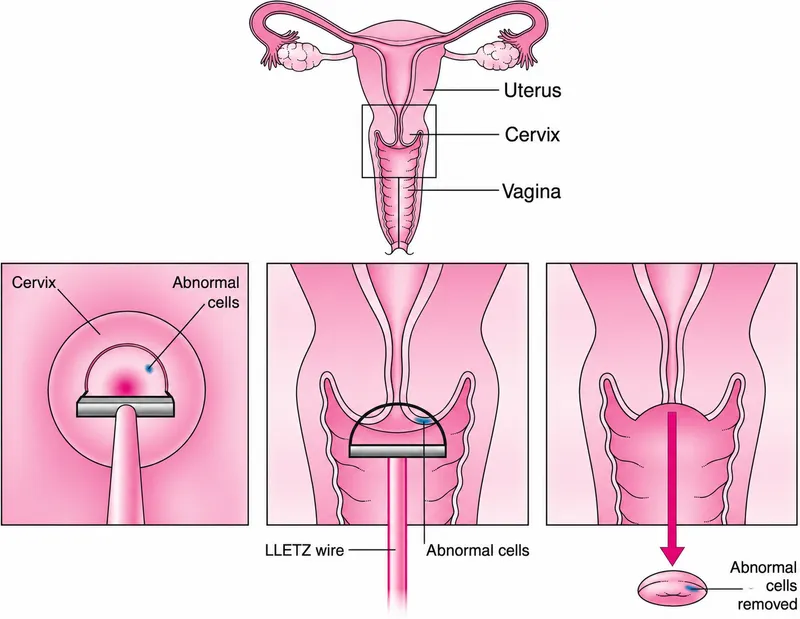 LEEP procedure diagram showing excision of cervical cells