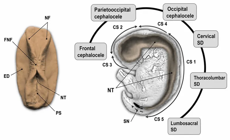 Neural tube closure and related malformations