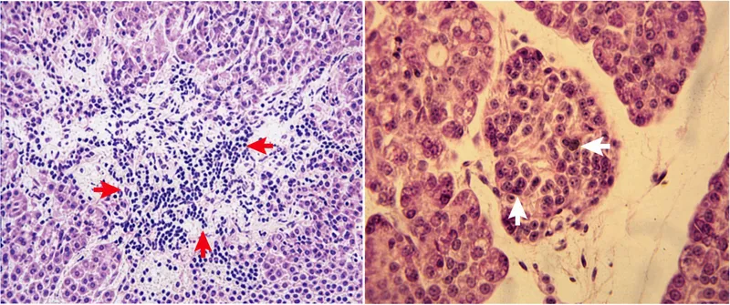 Pancreatic islet histology: insulitis vs. normal islet