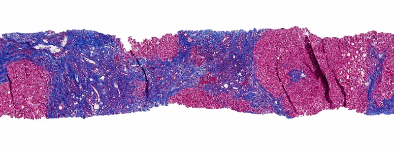 Cirrhosis histology: fibrous septa and regenerative nodules