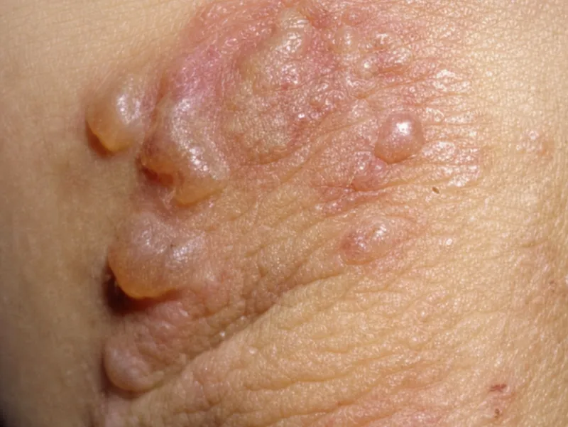 Dermatitis herpetiformis vesicles on elbows