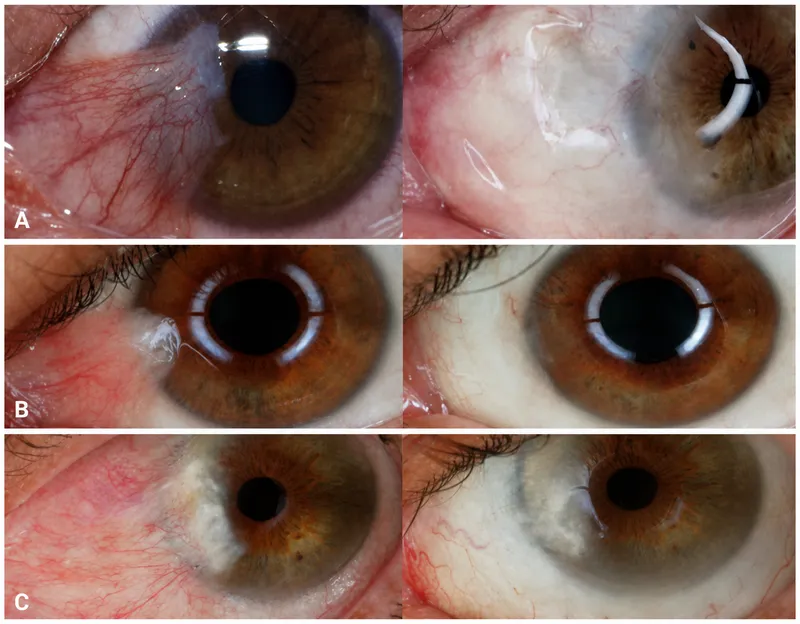 Pre- and post-op pterygium removal (PERFECT technique)