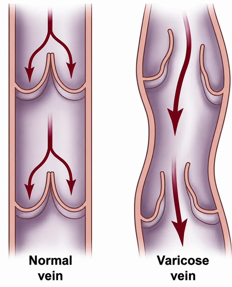 Normal vs. varicose vein with valvular insufficiency