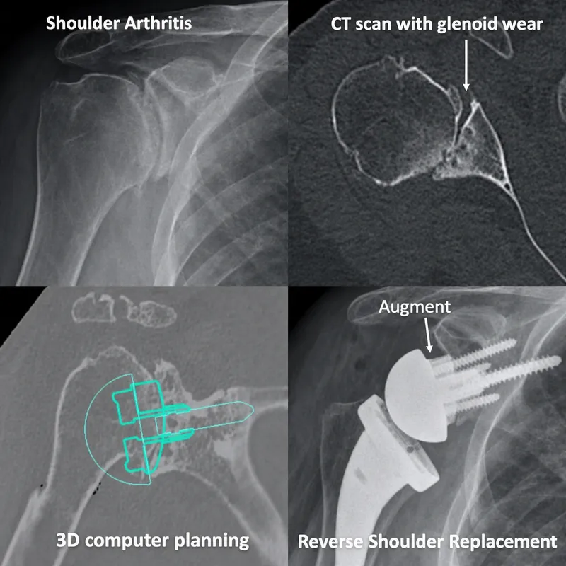 Shoulder Arthroplasty Planning and Result